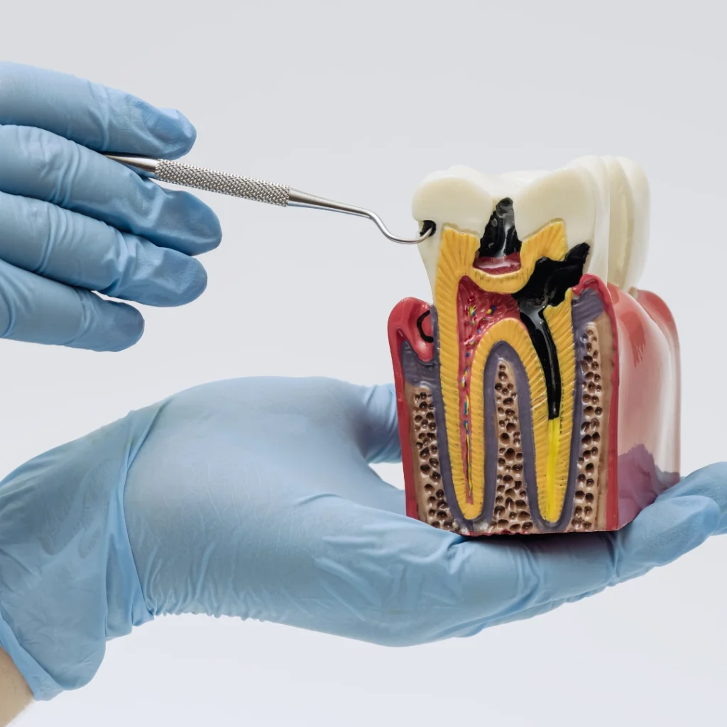 Devitalizzazione dente a Saluzzo