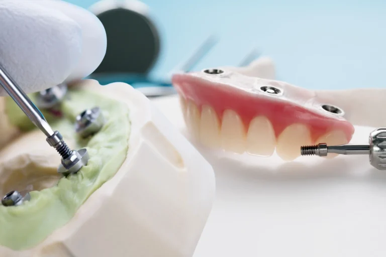 Impianti dentali e estetica del sorriso