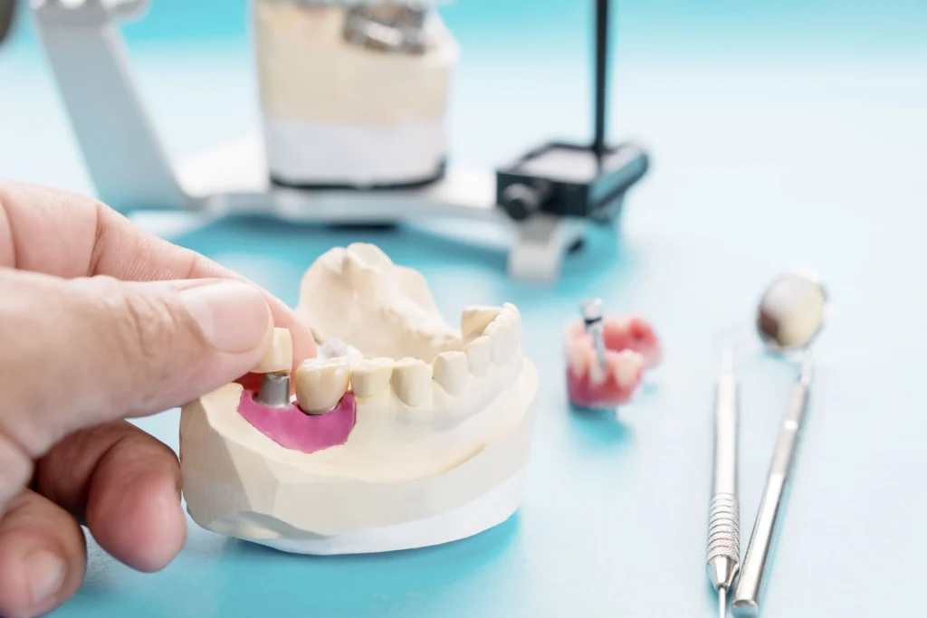 Come funziona un impianto dentale: spiegazione semplice 2 Come funziona un impianto dentale