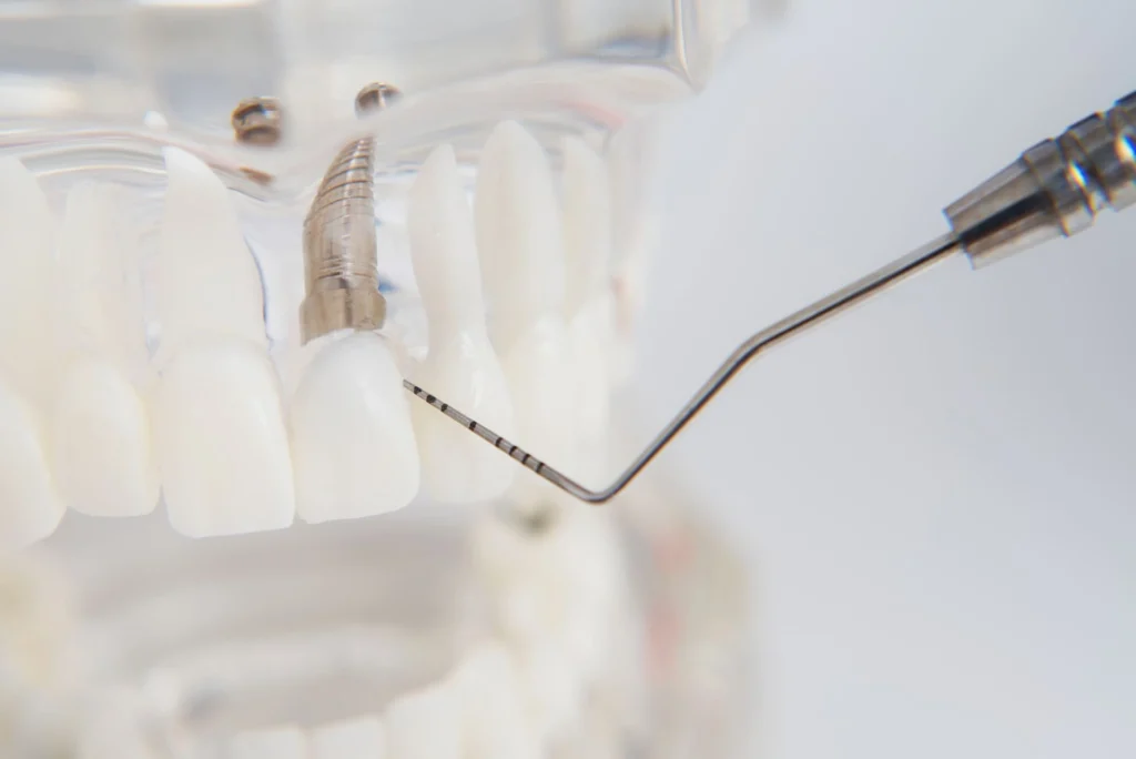 Come funziona un impianto dentale: spiegazione semplice 1 Come funziona un impianto dentale