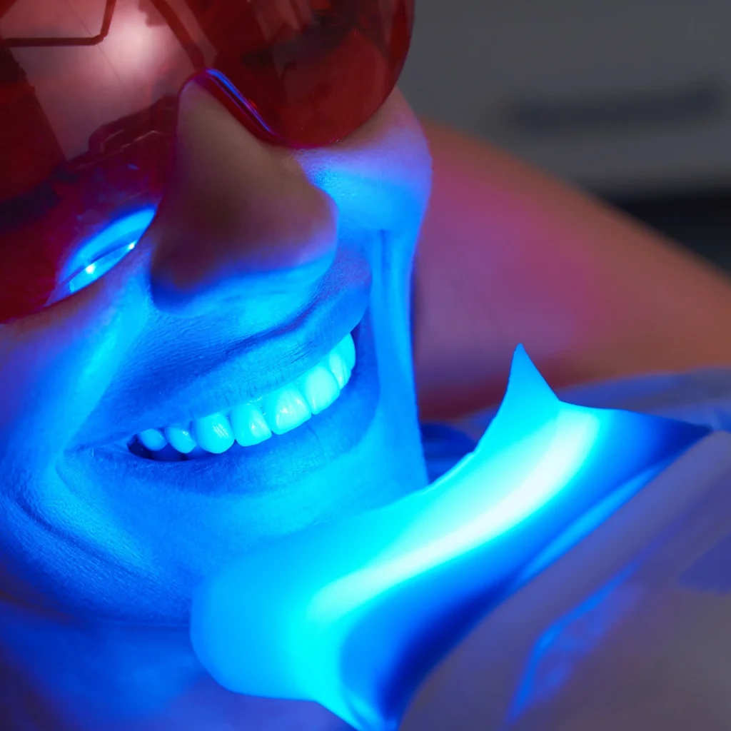 Sbiancamento dentale a Saluzzo