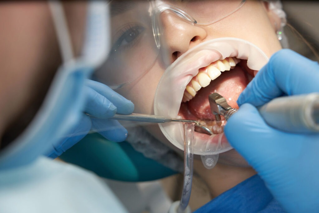 dolore dopo estrazione dente del giudizio