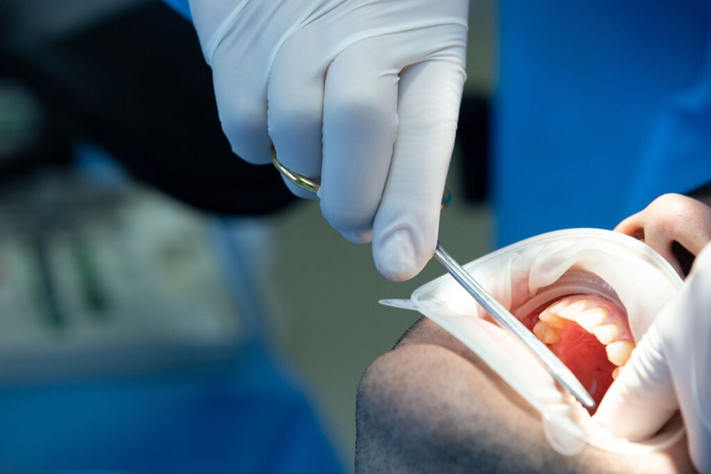 dolore dopo estrazione dente del giudizio