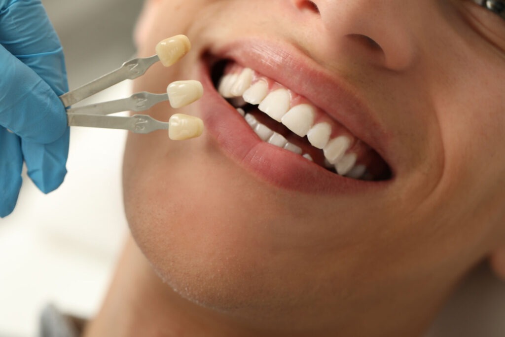 prodotti per pulire le faccette dentali